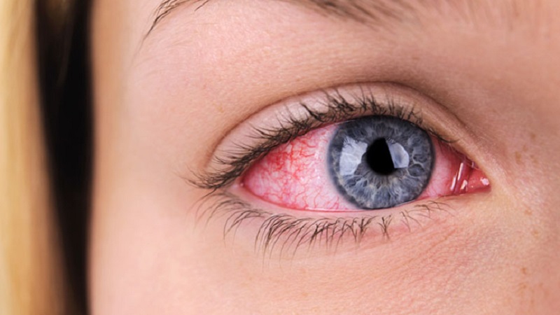 علت درمان قرمزی چشم 