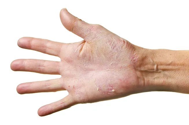 روش درمان اگزمای دست 