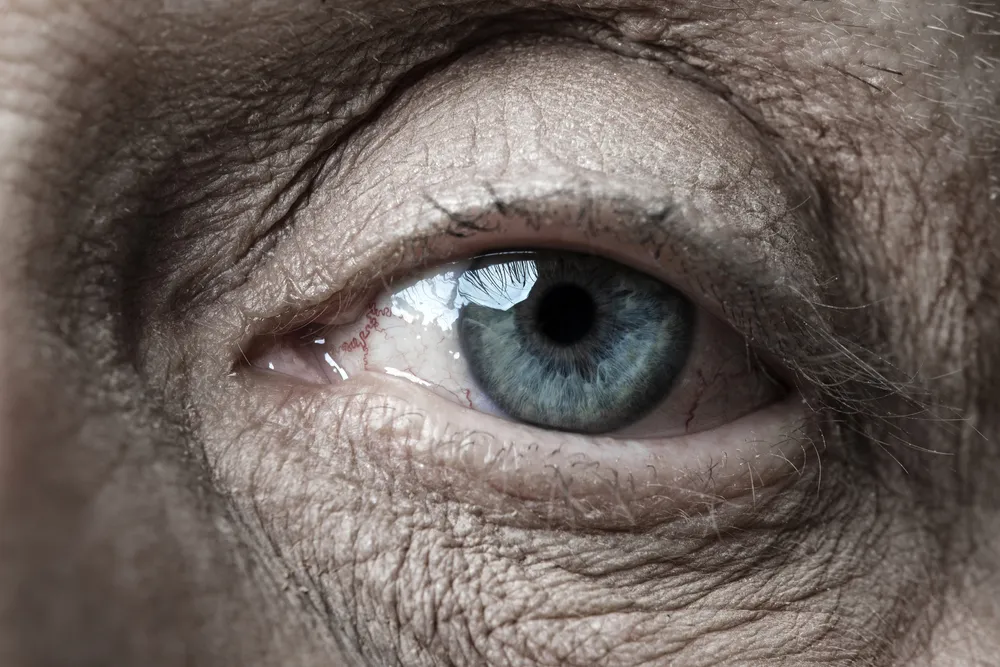 درمان پیر چشمی چیست