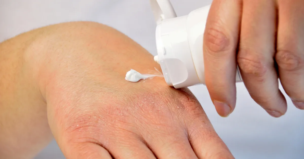 علت خشکی پوست دست 