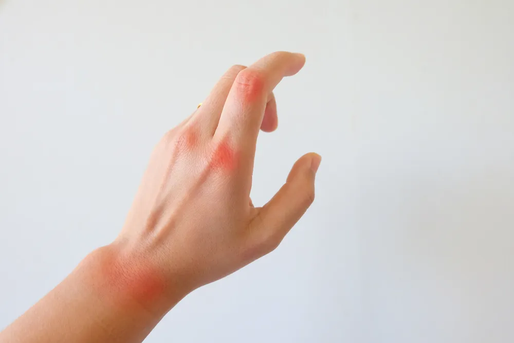 علائم آرتروز دست چیست