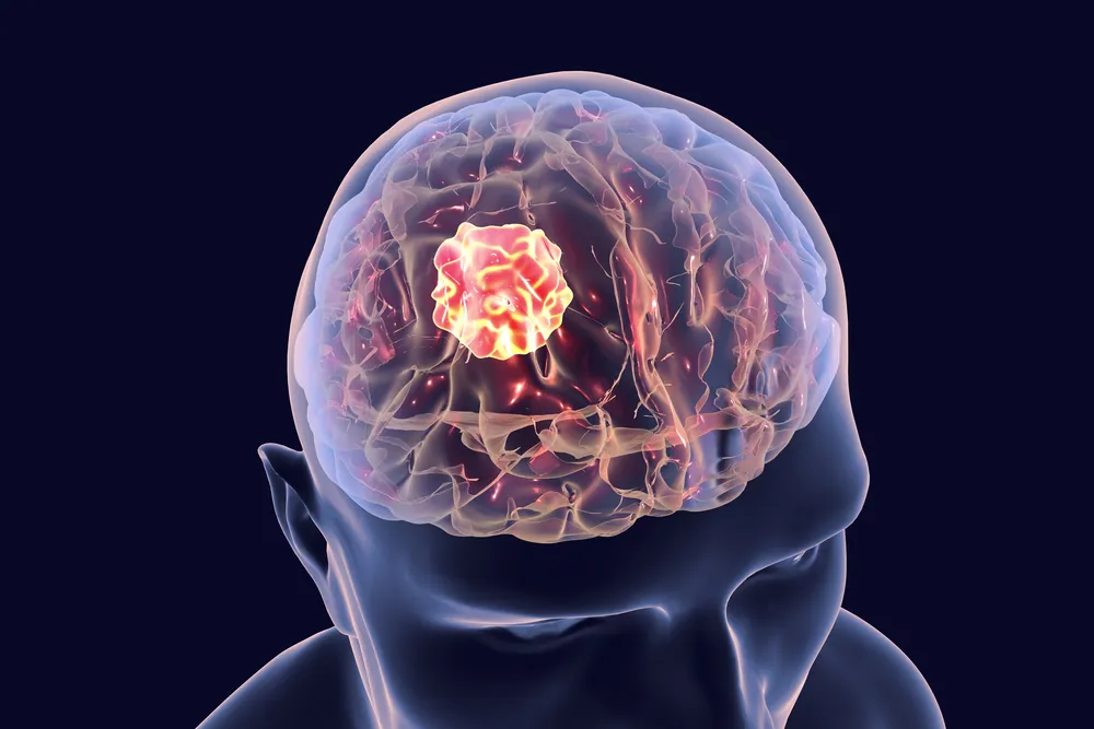 تشخیص تومور مغزی بدخیم