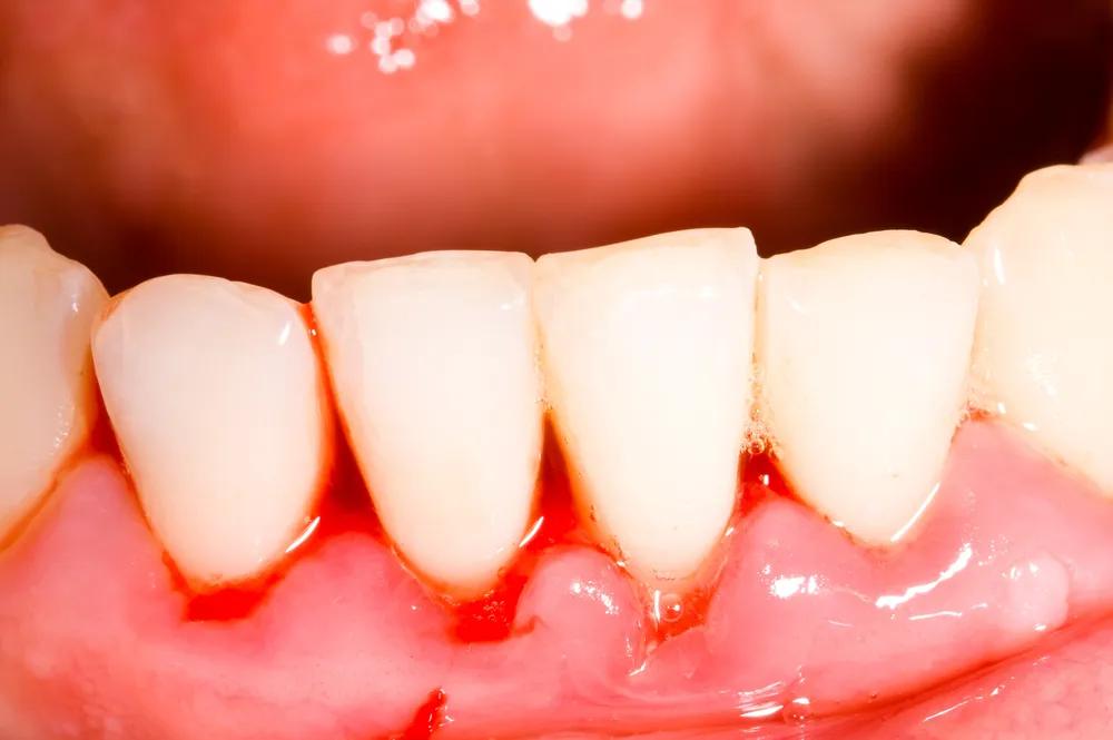تشخیص پریودنتال دندان 