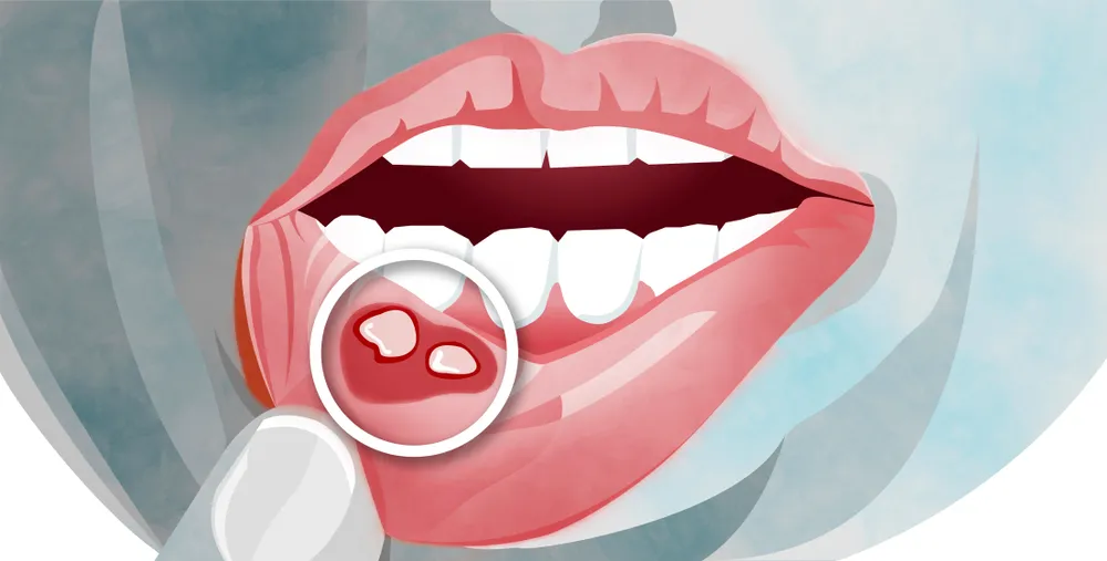 علت آفت دهان چیست؟ | روش های درمان آفت دهان