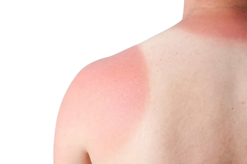 درمان آفتاب سوختگی پوست چطور است