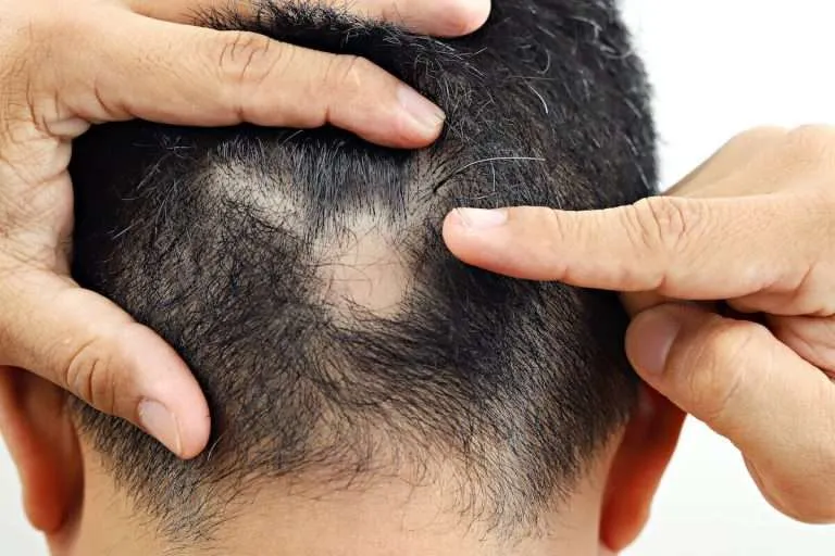 درمان قطعی ریزش موی سکه ای