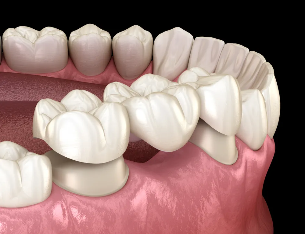 طول عمر بریج دندان چقدر است؟