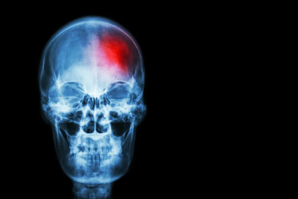 راههای جلوگیری از سکته مغزی چیست