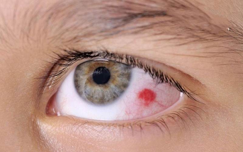 راه درمان خون افتادن چشم 